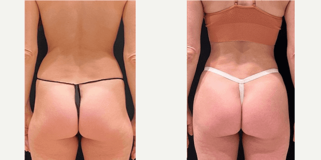 Body Lift procedure image