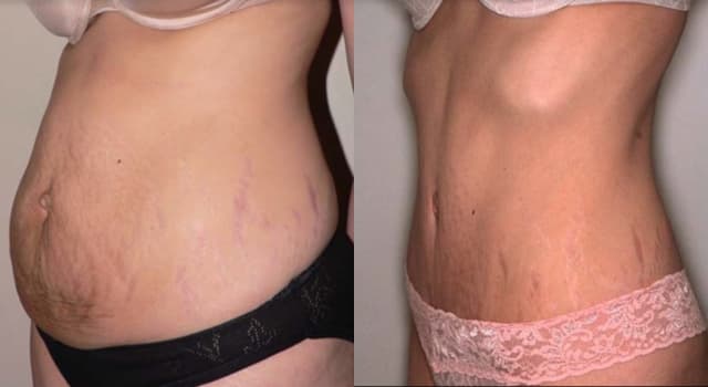 Skin Tightening procedure image