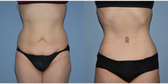 Mommy Makeover procedure image