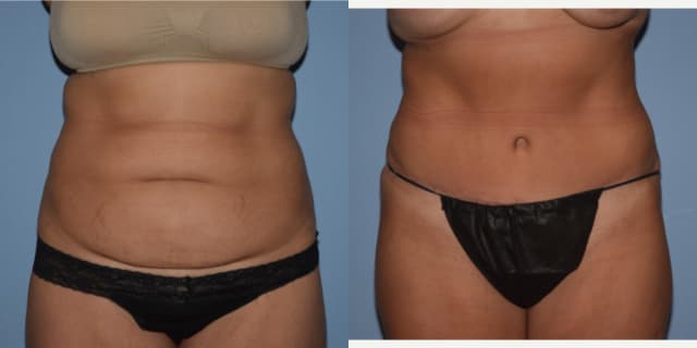 Tummy Tuck (Abdominoplasty) procedure image