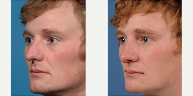 Facelift procedure image