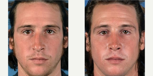 Rhinoplasty (Nose Job) procedure image