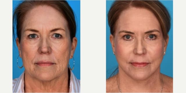 Cheek Enhancement procedure image