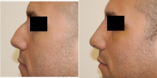 Rhinoplasty (Nose Job) procedure image