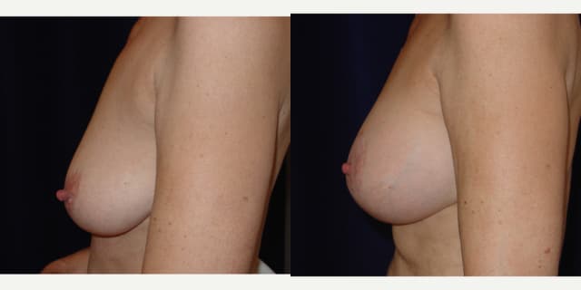 Breast Lift (Mastopexy) procedure image