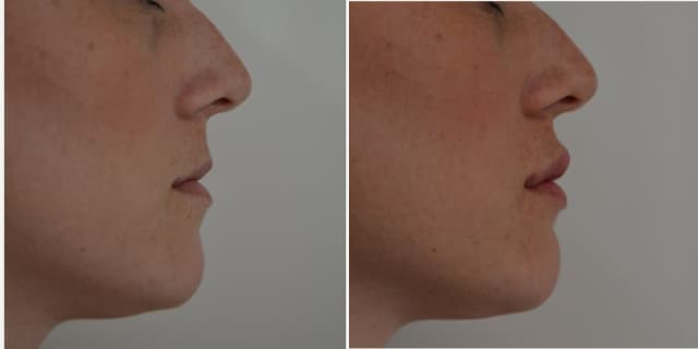 Lip Enhancement (Fillers) procedure image