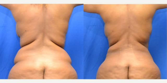 Lipo 360 procedure image