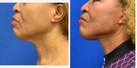 Skin Tightening procedure image