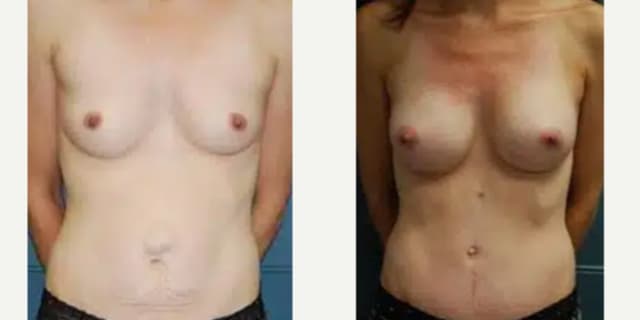 Breast Augmentation procedure image