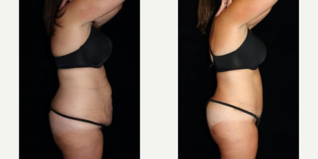 Tummy Tuck (Abdominoplasty) procedure image