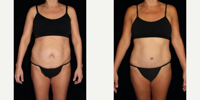 Mommy Makeover procedure image