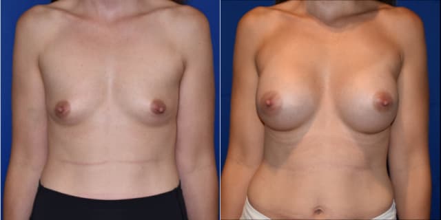 Breast Augmentation procedure image