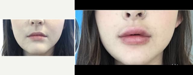 Fillers & Injectables (e.g. Botox, Juvederm) procedure image