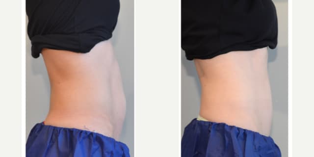 Lipo 360 procedure image