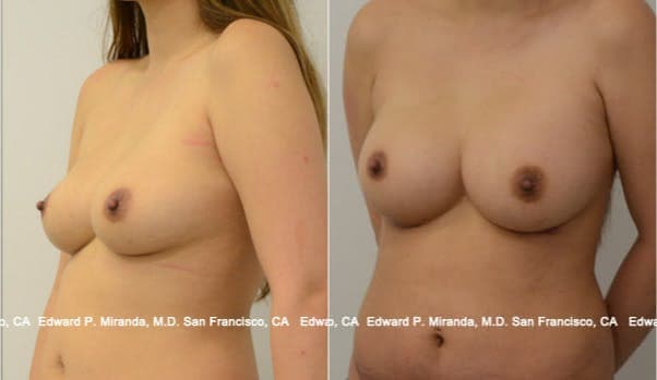 Breast Augmentation procedure image