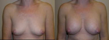 Mommy Makeover procedure image