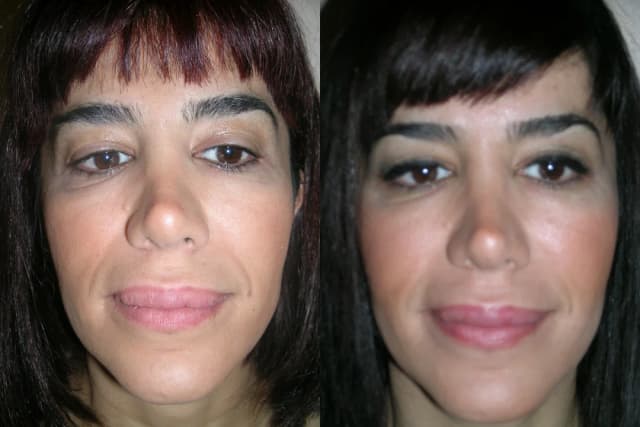 Lip Reduction procedure image
