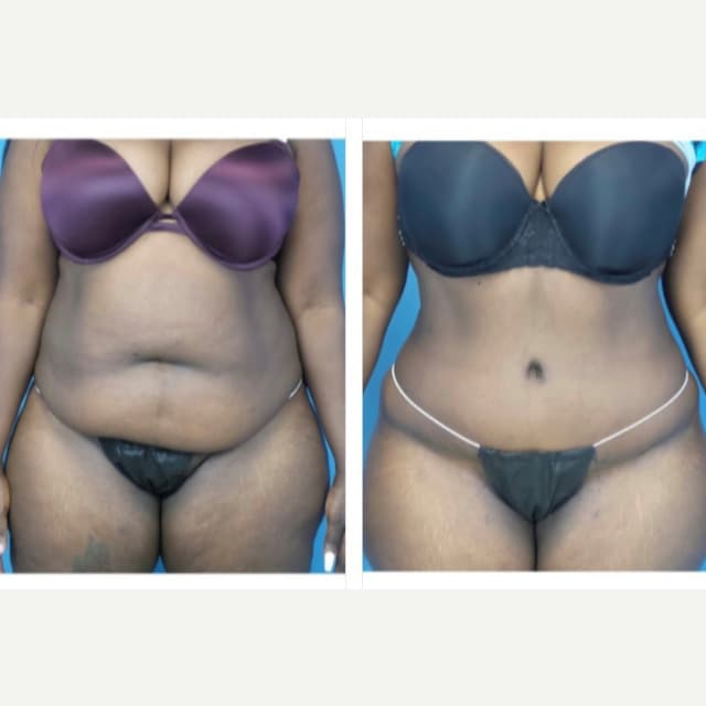 Skin Tightening procedure image