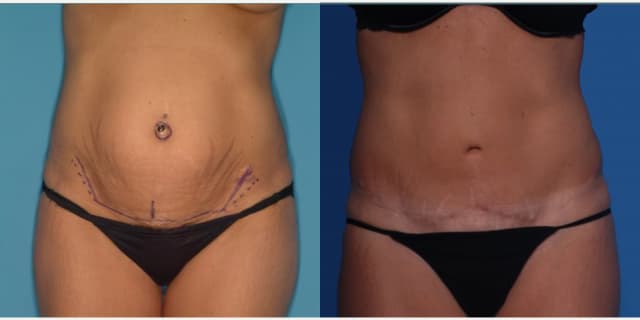 Mommy Makeover procedure image