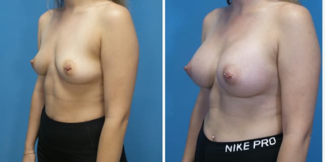 Breast Augmentation procedure image