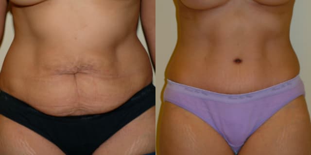 Mommy Makeover procedure image