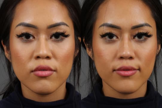 Cheek Enhancement procedure image