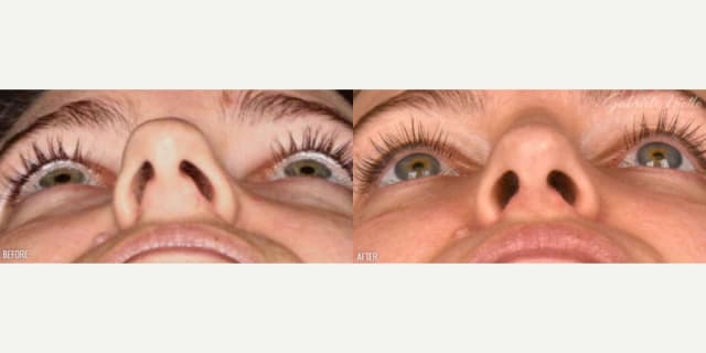 Rhinoplasty (Nose Job) procedure image