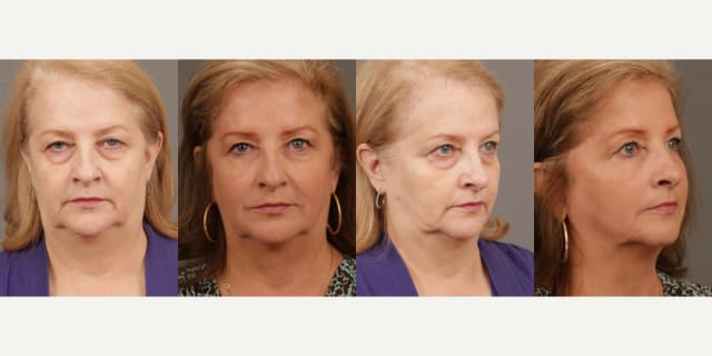 Fillers & Injectables (e.g. Botox, Juvederm) procedure image