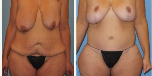 Tummy Tuck (Abdominoplasty) procedure image