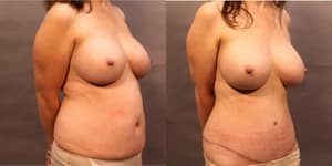 Tummy Tuck (Abdominoplasty) procedure image
