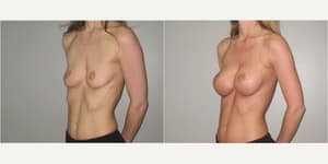 Breast Augmentation procedure image