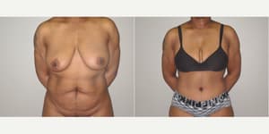 Mommy Makeover procedure image