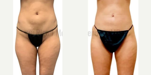 Body Lift procedure image