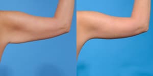 Body Lift procedure image