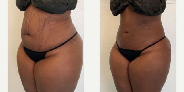 Tummy Tuck (Abdominoplasty) procedure image