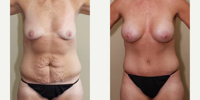 Body Lift procedure image