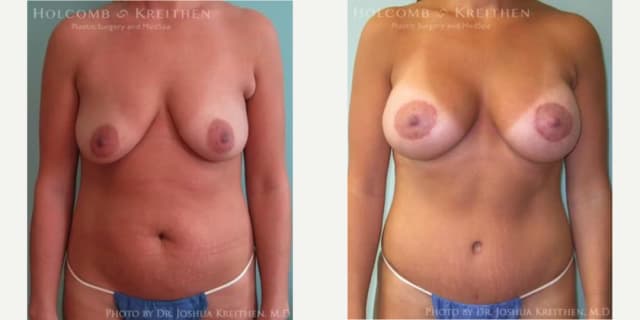 Breast Augmentation procedure image