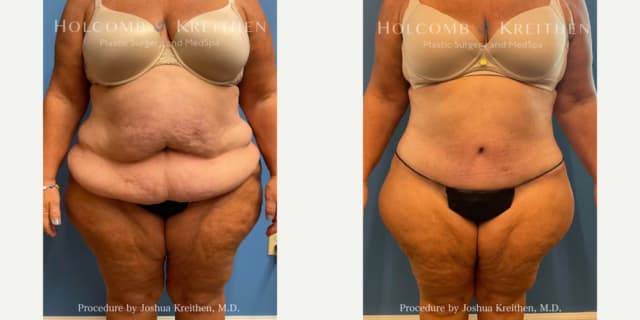 Tummy Tuck (Abdominoplasty) procedure image