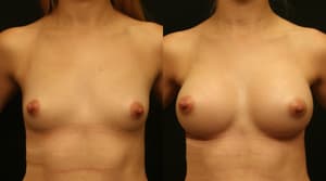 Mommy Makeover procedure image