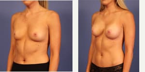 Skin Tightening procedure image