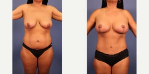 Breast Augmentation procedure image