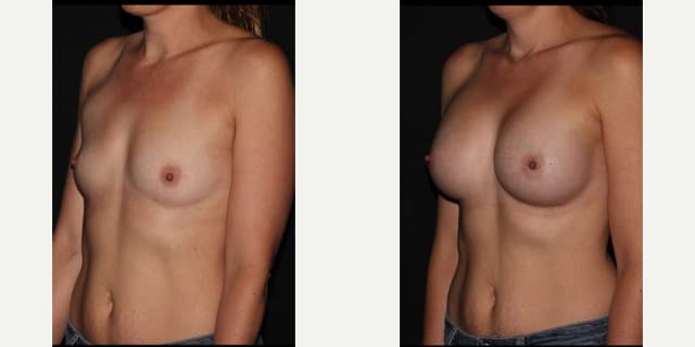 Mommy Makeover procedure image