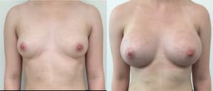 Breast Augmentation procedure image