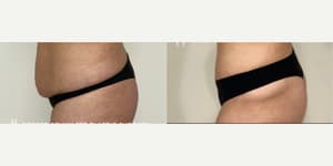 Skin Tightening procedure image