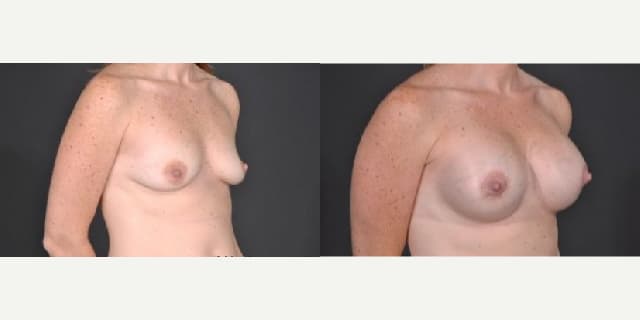 Breast Augmentation procedure image