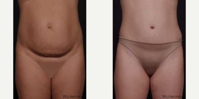 Skin Tightening procedure image