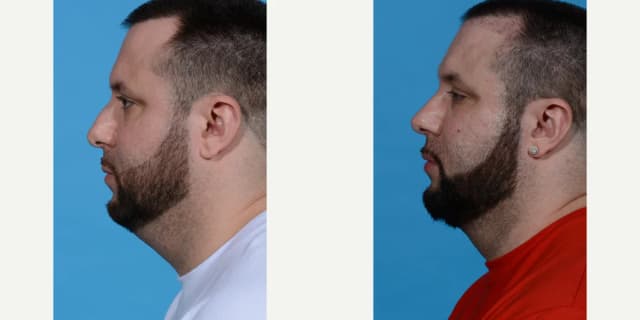 Rhinoplasty (Nose Job) procedure image