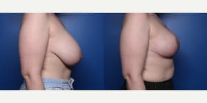 Mommy Makeover procedure image