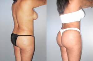 Hip Enhancement procedure image