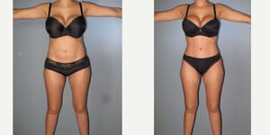 Tummy Tuck (Abdominoplasty) procedure image
